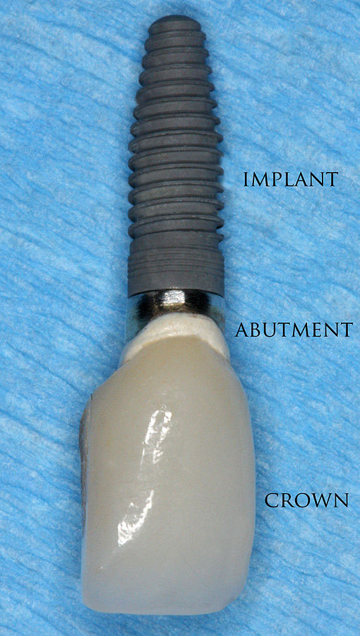 Tooth implant with labels